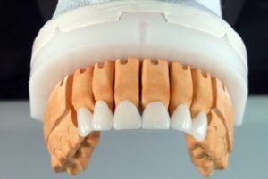 коронки на передние зубы
